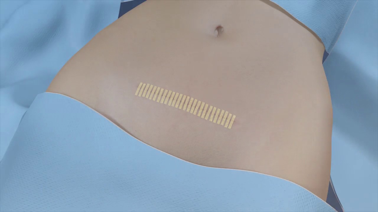 Three Steps for Post-Operative Care Video