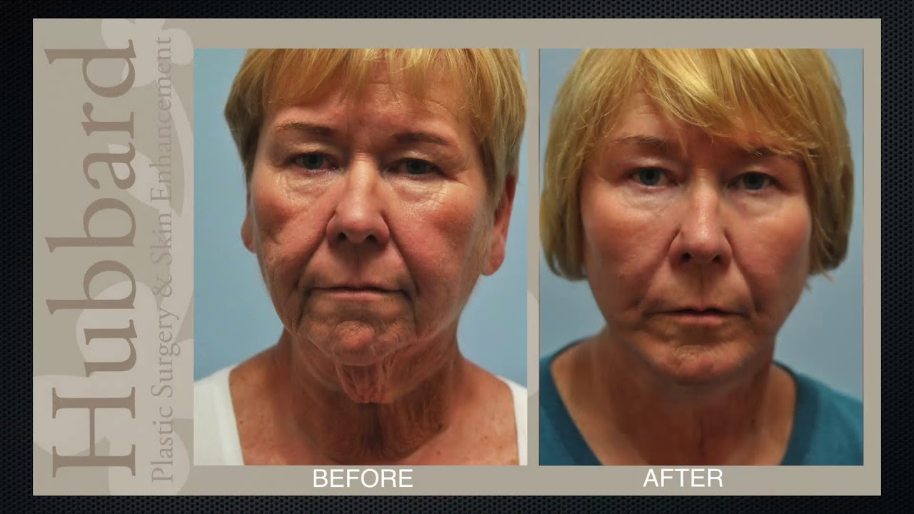 Virginia Beach woman Feels Fabulous at 60 after Facelift and Tummy Tuck - Hubbard Plastic Surgery