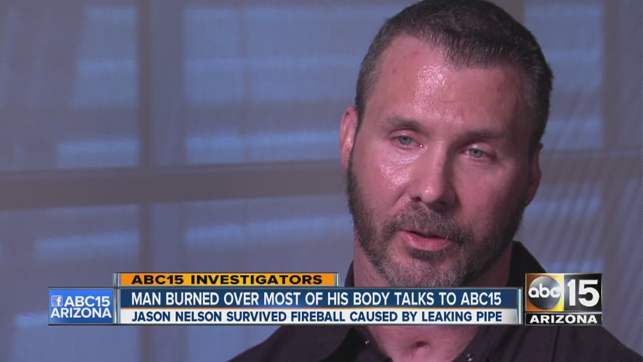 Gilbert nan burned over most of his body talks to ABC15