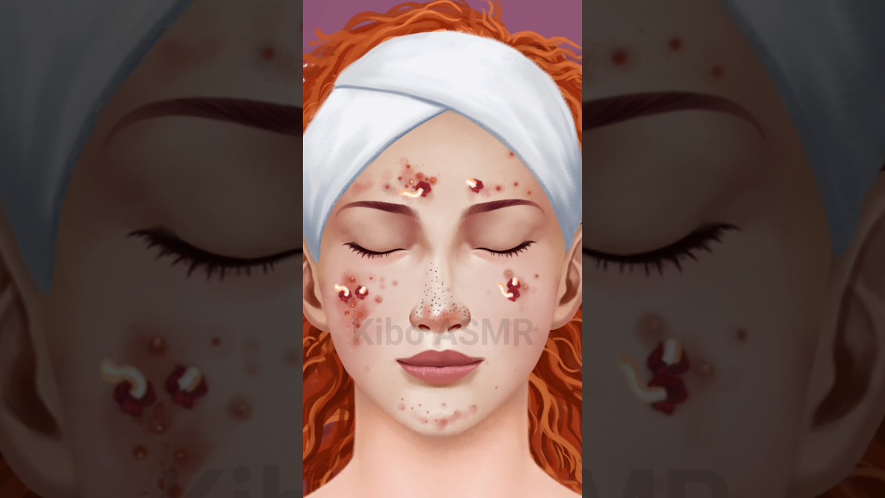 Oddly Satisfying Dirty Face Acne & Blackheads Extraction #asmr #animation #oddlysatisfying