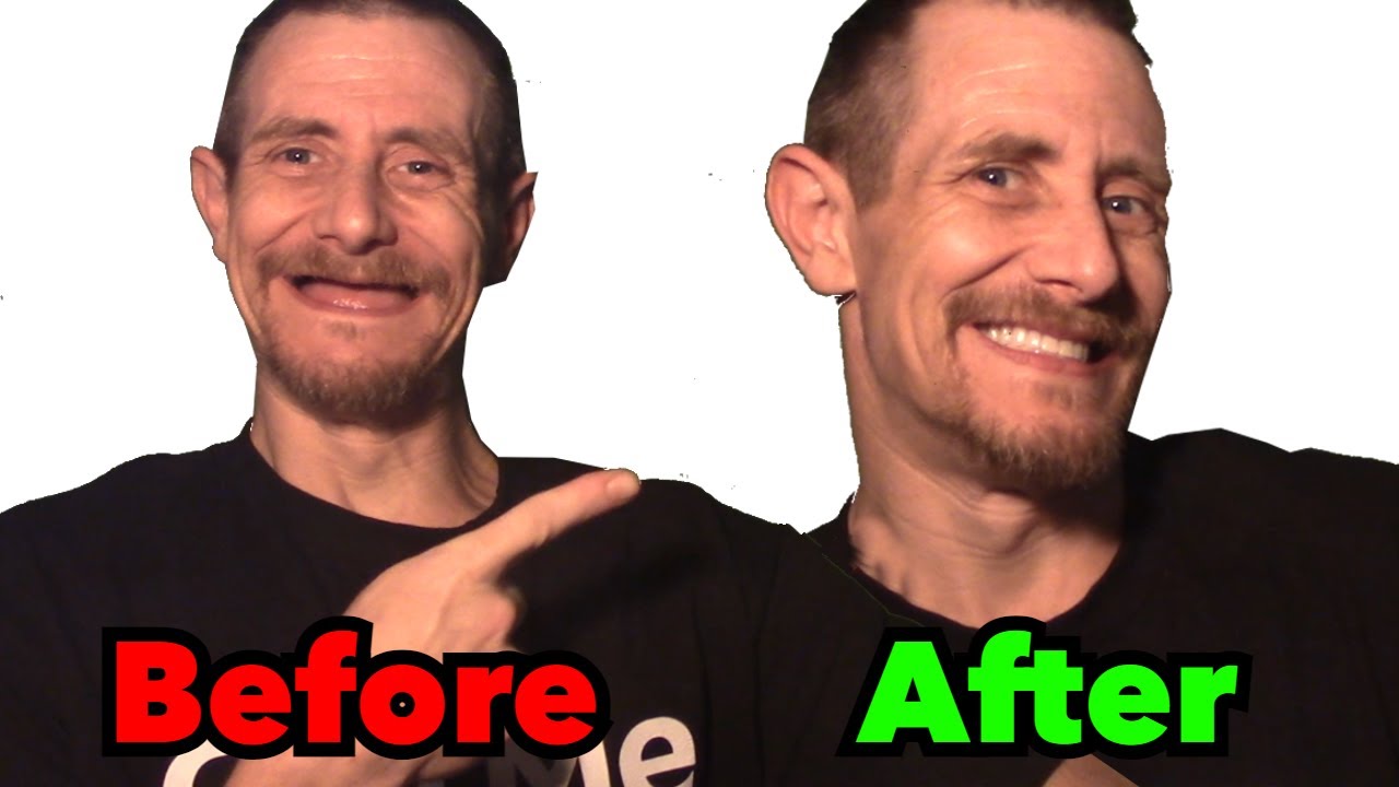 My new smile | Affordable dentures vs Dentist dentures!