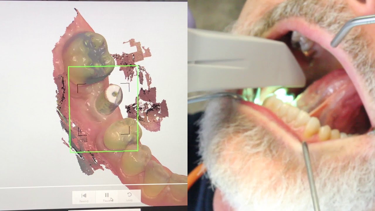 Trios Scan of Elos Scan Body for a Molar Implant
