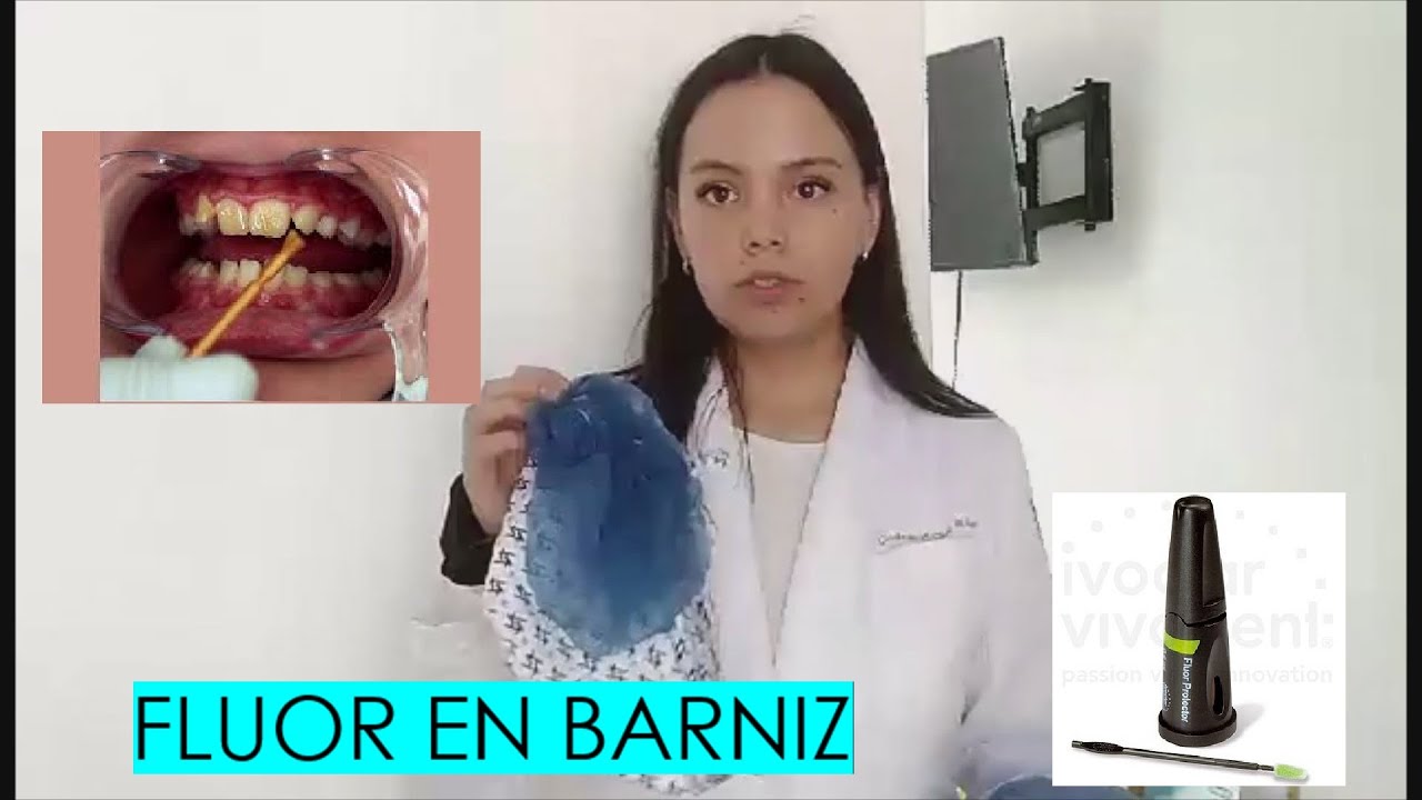 Practica figurada de APLICACION DE FLUOR EN BARNIZ