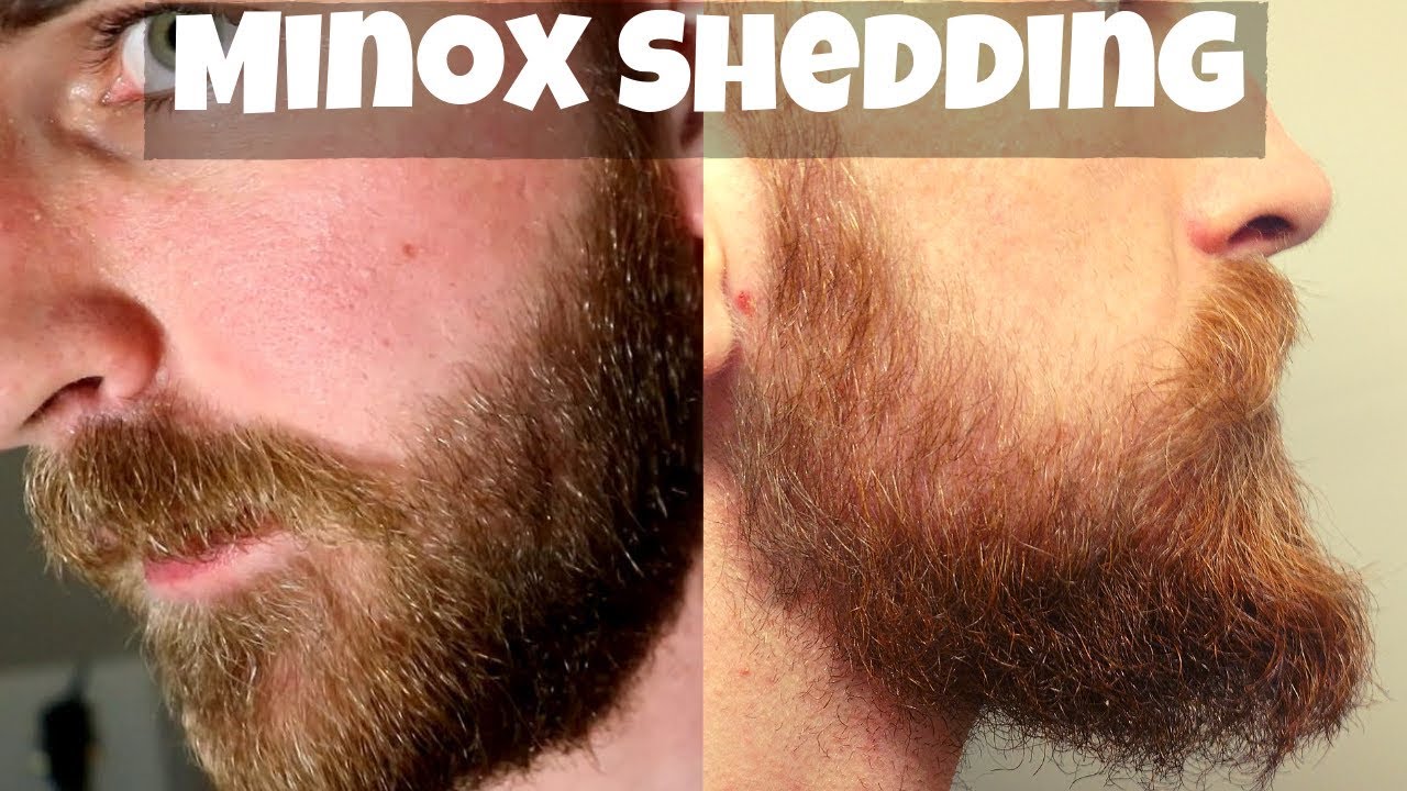 BRUTAL Minoxidil Shedding Phases, IRL Beard Transformation Reactions | Q&A #1