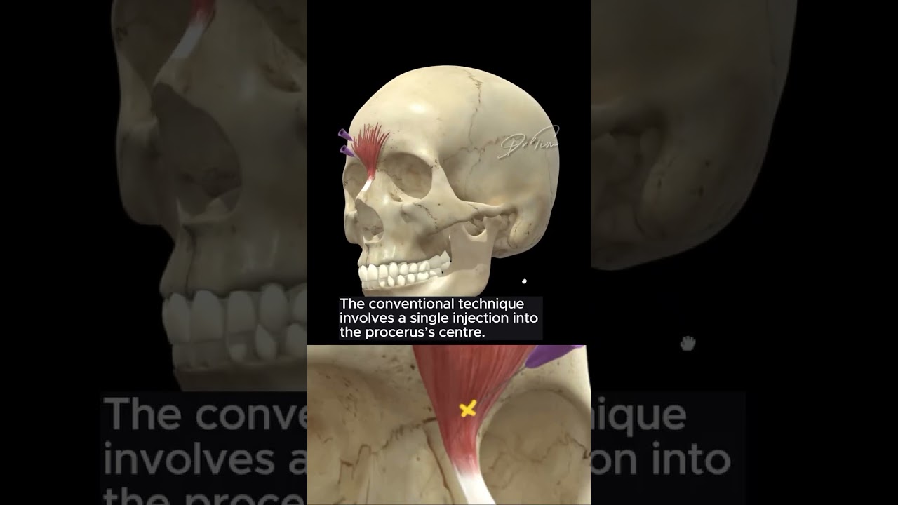 Procerus