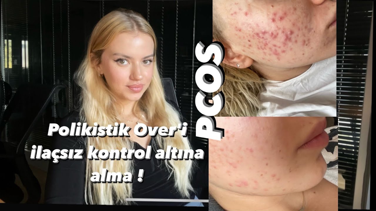 PCOS ( SİVİLCE/ KİLO ) I Polikistik Over’i İlaçsız Kontrol Altına Almak Mümkün!!