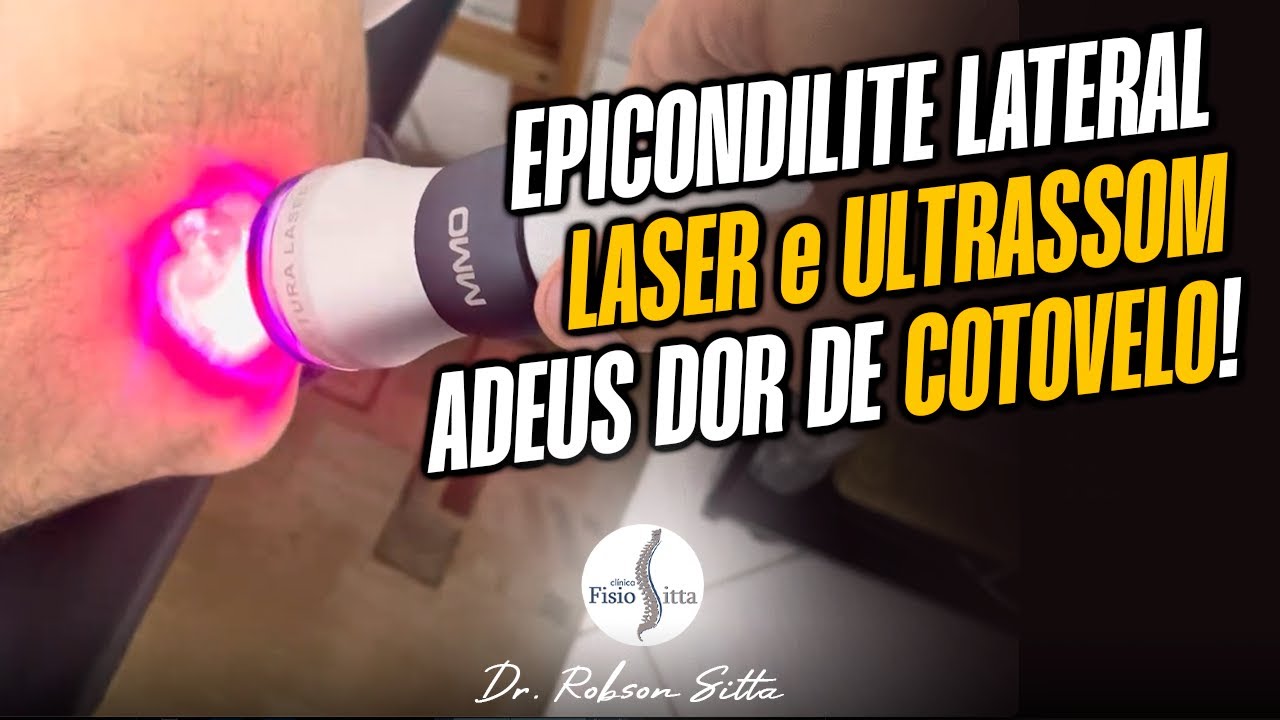 EPICONDILITE LATERAL do COTOVELO - FISIOTERAPIA com LASER + ULTRA-SOM SIMULTÂNEO - Dr. Robson Sitta