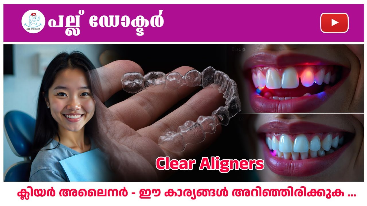 ക്ലിയർ അലൈനർ - ഈ കാര്യങ്ങൾ അറിഞ്ഞിരിക്കുക ...Pallu Doctor | Nechupadam Dental Clinic Kochi