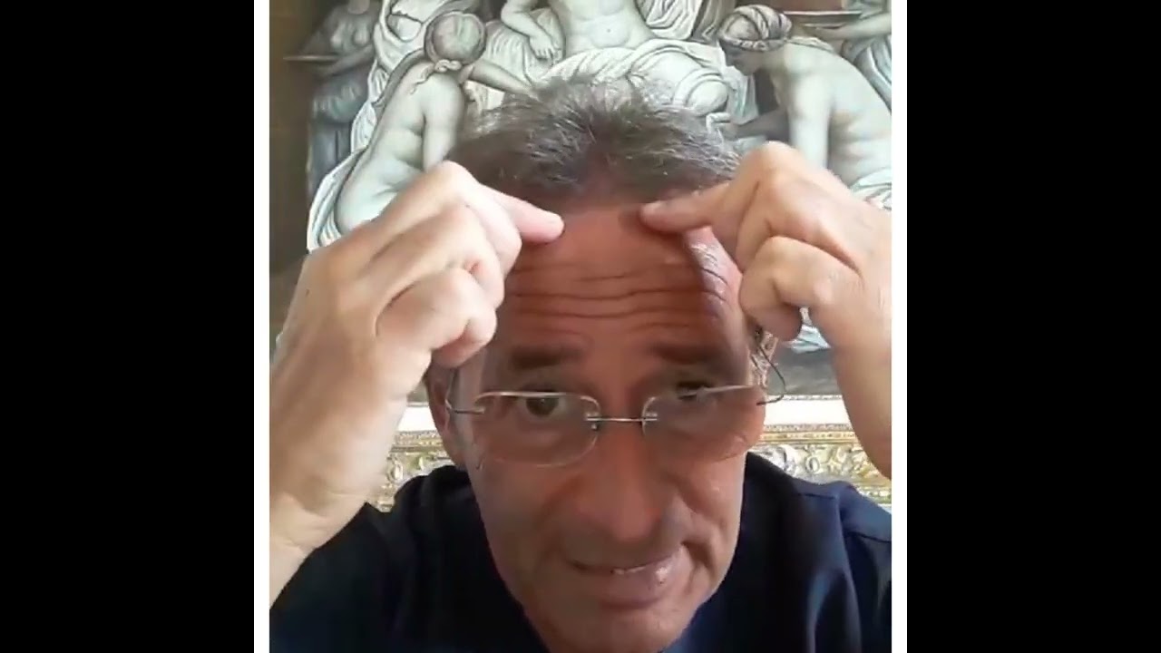 Alopecia Fibrosante Frontale