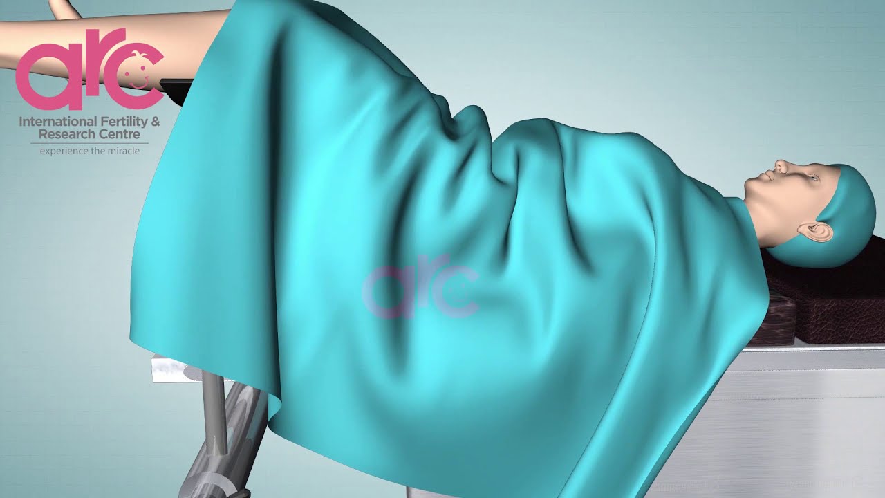 ИКСИ 3D видео - Внутрицитоплазматическая инъекция сперматозоидов - Этапы, процесс. Клиники по леч...