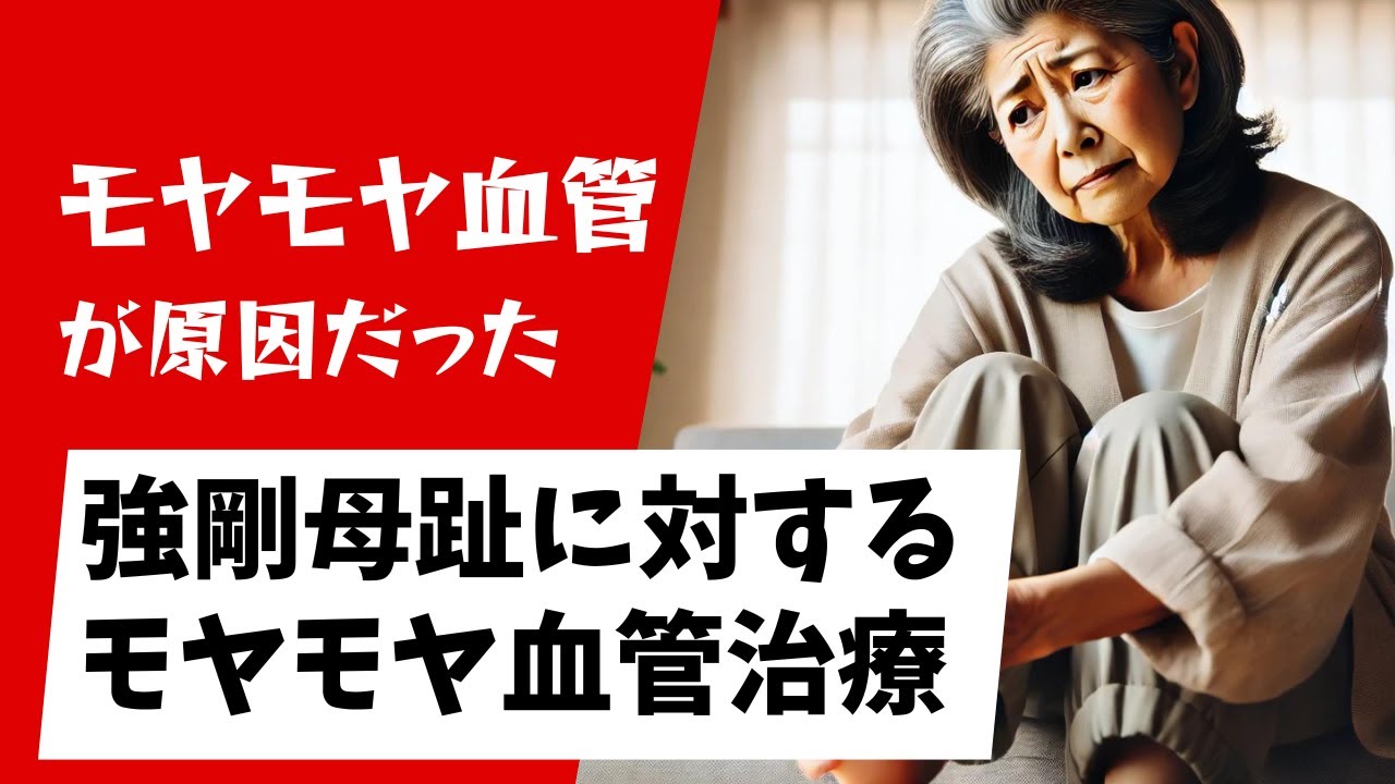 親指の付け根が痛い・・外反母趾ではない強剛母趾に対するモヤモヤ血管治療