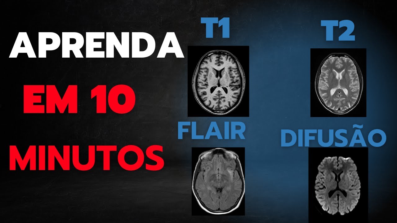 Sequências de Ressonância Magnética: Desvendando T1, T2, FLAIR e Difusão