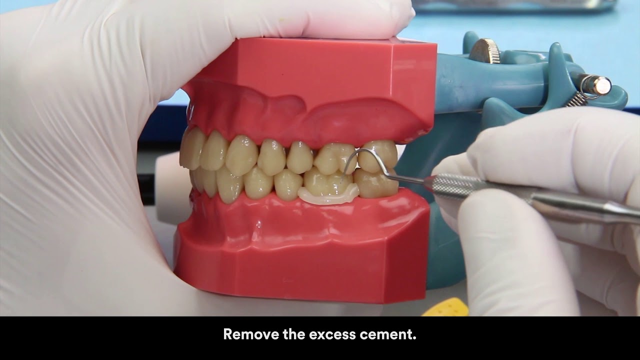 3M RelyX Unicem 2 clicker cementation zirconia crown