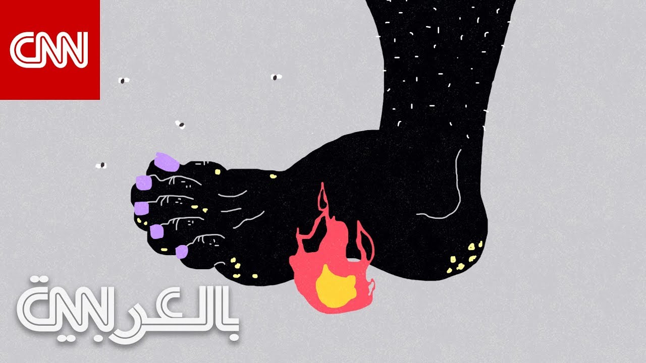 أبرز أسباب تعرّق الأقدام وطرق علاجها