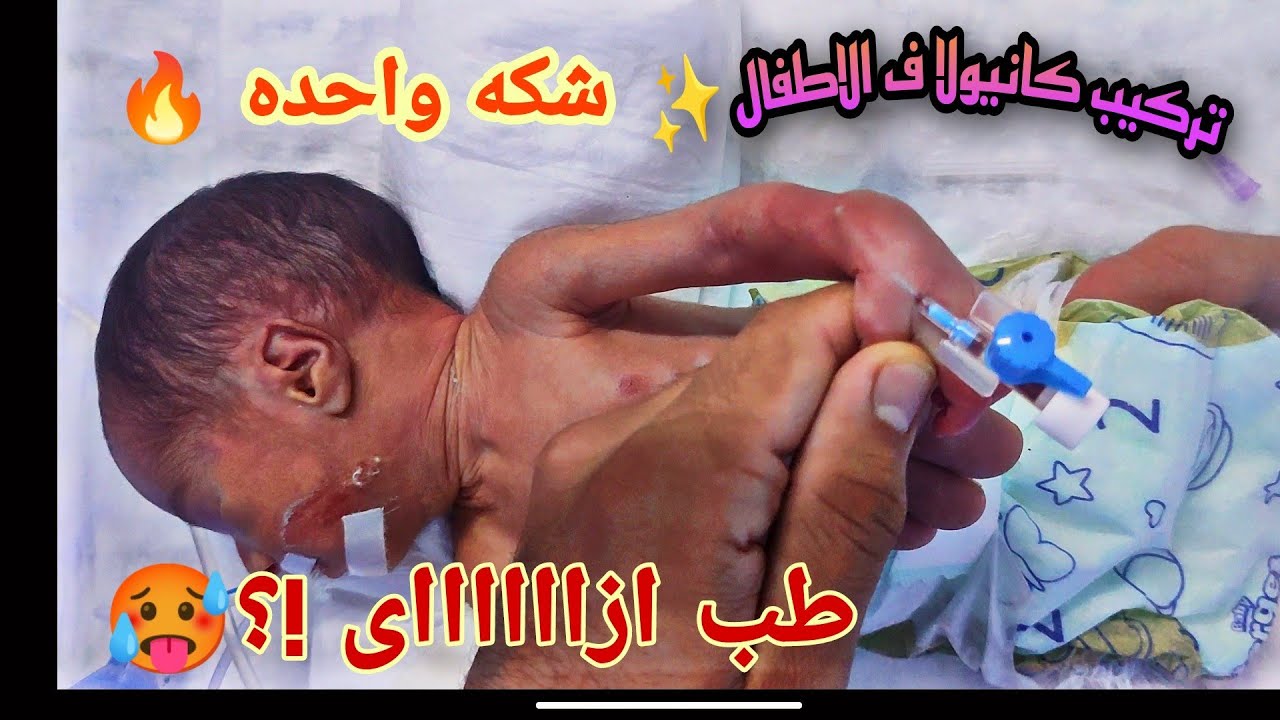 طريقة تركيب كانيولا ف الاطفال المبتسرين من شكة واحده