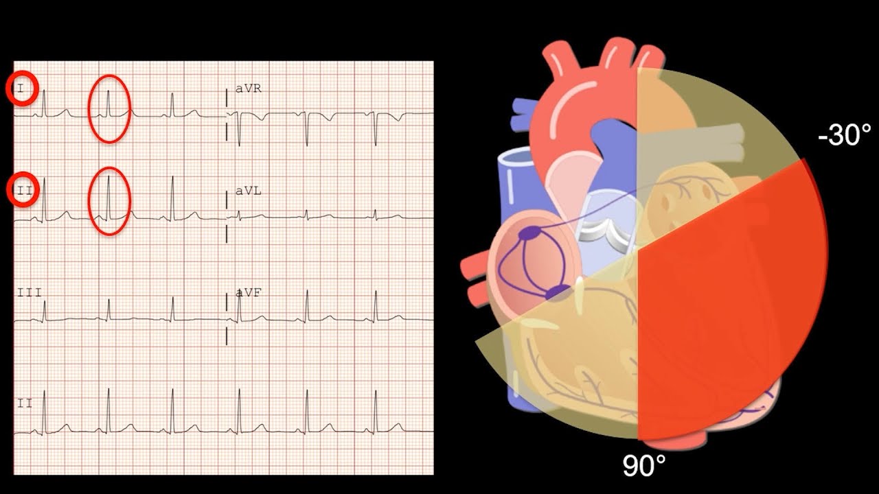How to Read an ECG: Determining QRS Axis, Causes of left and right axis deviation.
