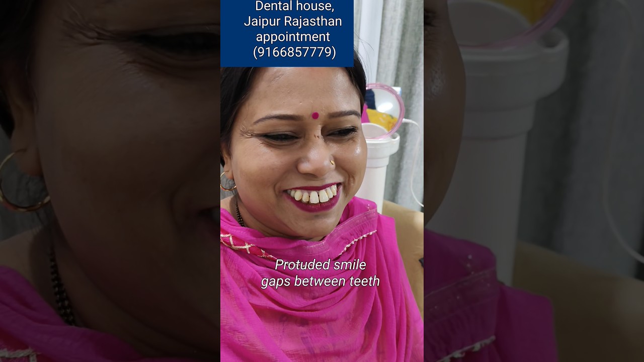 बाहर निकले दांतो का इलाज सिर्फ़ 3 दिन में // Smile design treatment// Jaipur