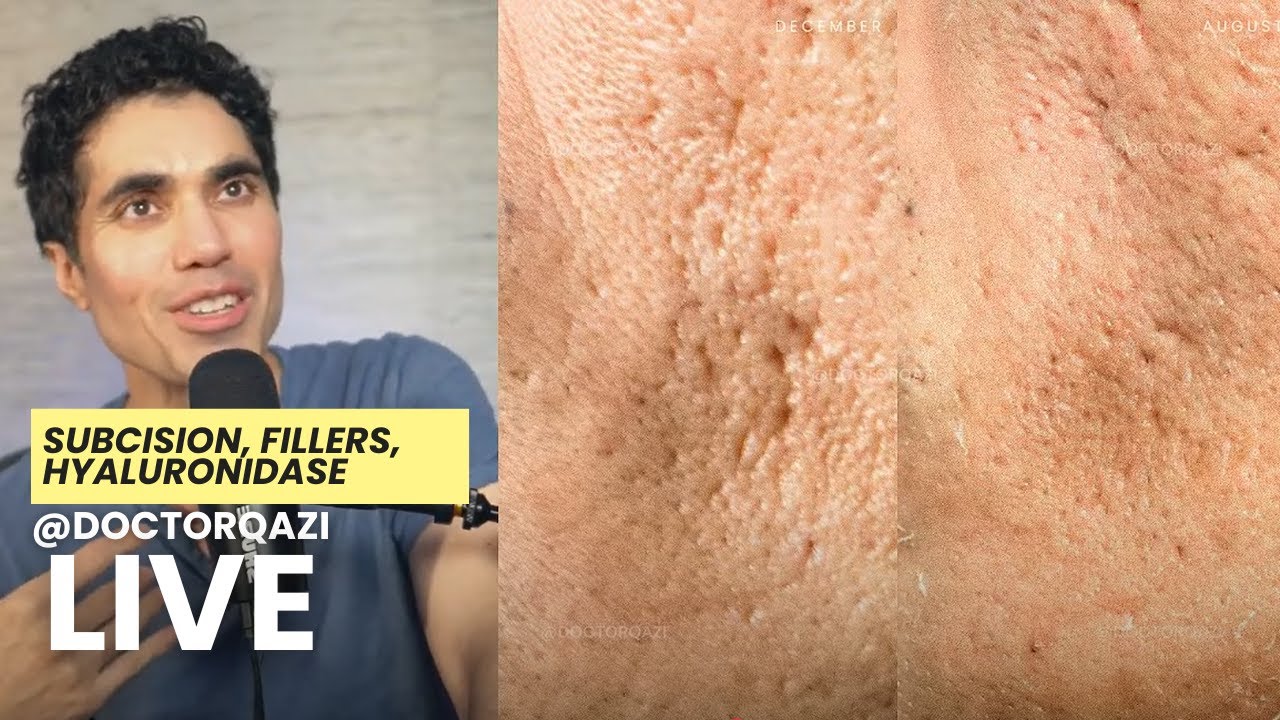 Dr. Qazi discusses Subcision, Fillers, Hyaluronidase | Dr. Qazi Unsponsored Live | 4.23.2025