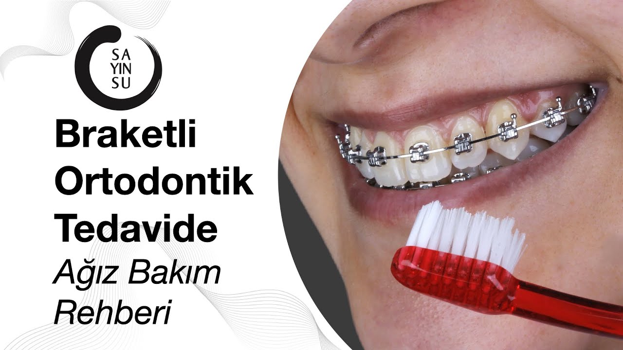 Braketli Ortodontik Tedavide Ağız Bakım Rehberi  |  Diş Telinin Temizliği ve Yeme İçme Kuralları