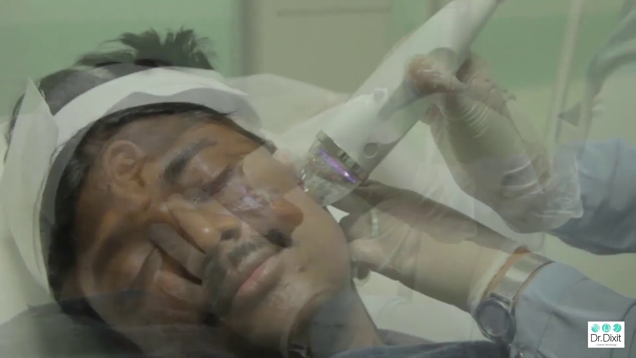 ACNE SCAR TREATMENT IN BANGALORE | DR RASYA DIXIT | ACNE CARE TIPS