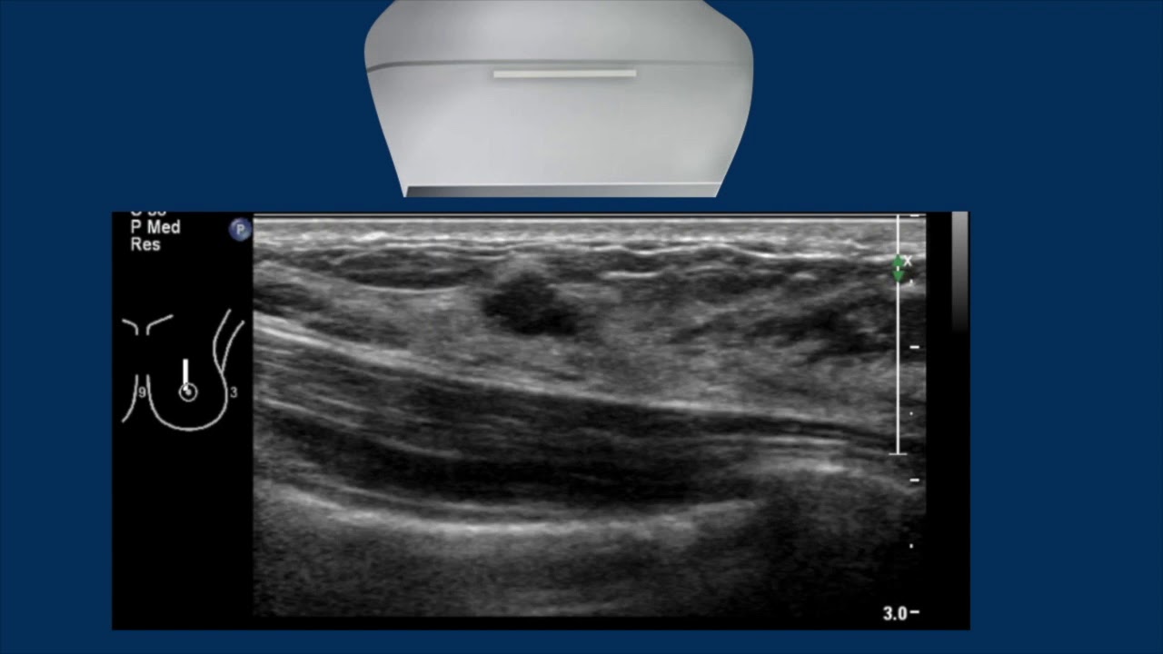 Breast Ultrasound   cancer 3