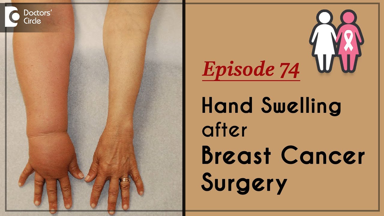 Prevent Swollen Arm Post Breast Cancer Surgery #breastcancer  - Dr. Sandeep Nayak | Doctors' Circle