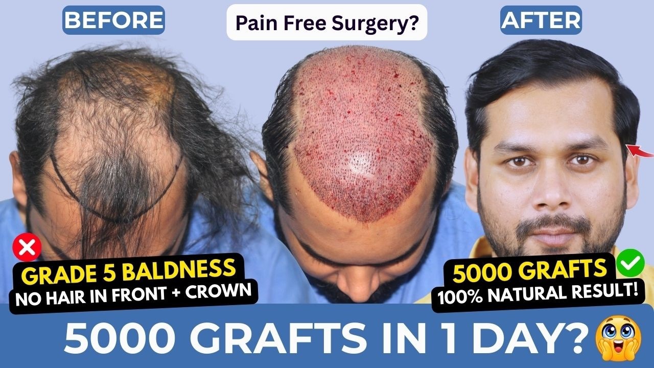 Облысение 5 степени | Результаты пересадки 5000 графтов волос | Medispa India | Доктор Сунит Сони