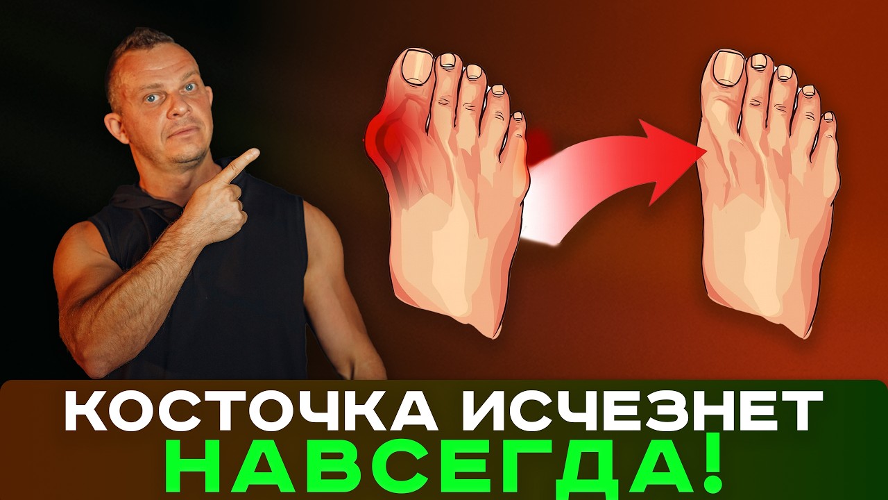 Только ЭТИ 4 УПРАЖНЕНИЯ уберут КОСТОЧКУ на большом пальце ноги. Исправь халюс вальгус без операций!