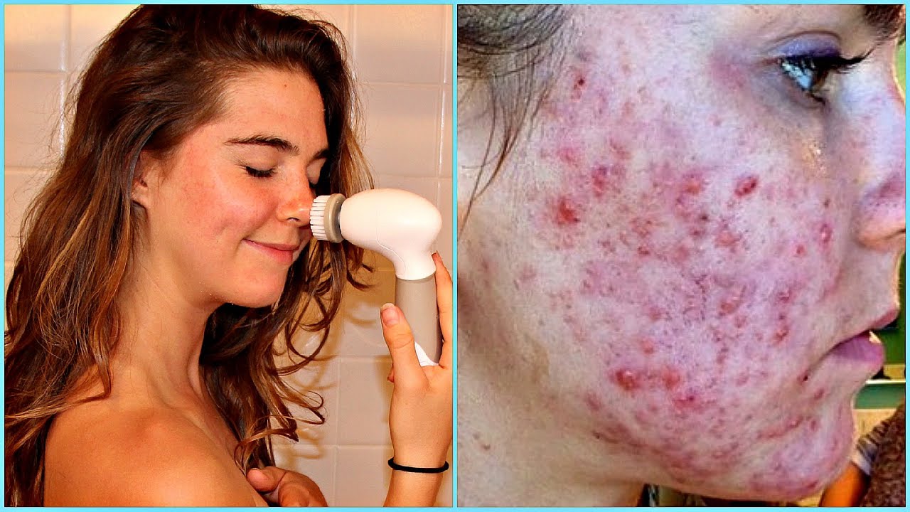 Clearing Acne Scars ROUTINE - ACNE UPDATE