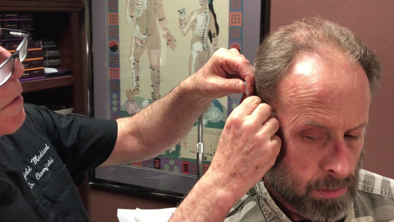 Reno Doctor William Clearfield  Battlefield Acupuncture for Treatment for Anxiety, Pain, Tinnitus