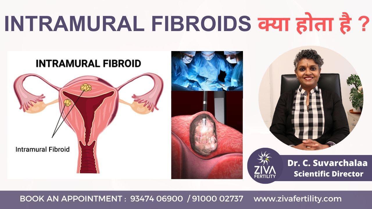 इंट्राम्यूरल फाइब्रॉएड: लक्षण, निदान और उपचार | Intramural Fibroid | Dr Suvarchala | ZIVA Fertility
