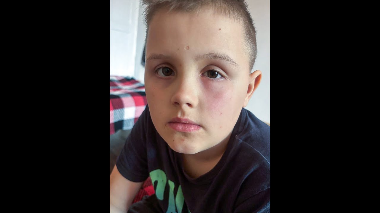 Ajută-l pe Igor să își păstreze vederea | Povestea unui băiat de 12 ani din Ucraina