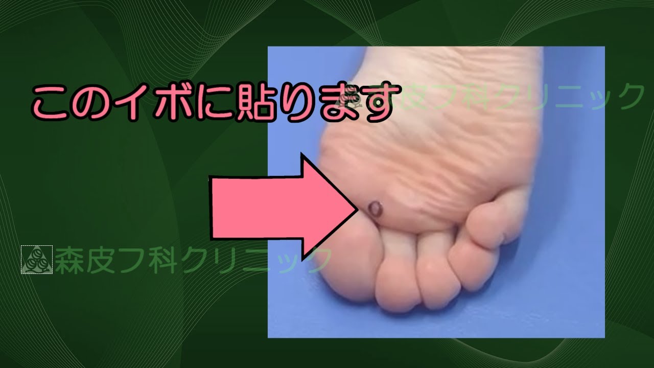【お薬の塗り方の説明】スピール膏の貼り方