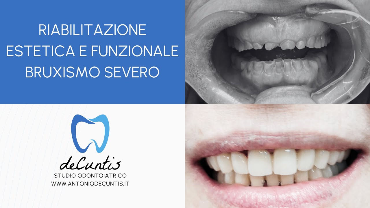 Riabilitazione Estetica e Funzionale di un caso di Bruxismo Severo - Dott. Antonio de Cuntis