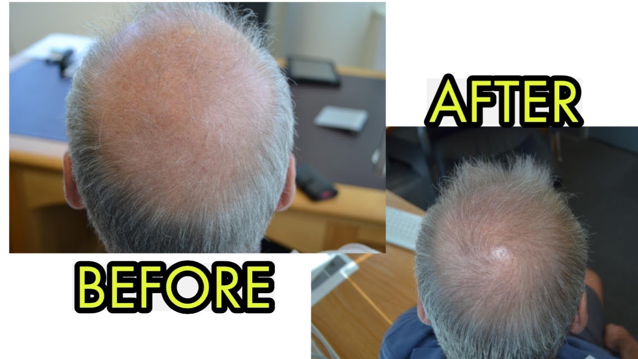 I CAN'T BELIEVE ORAL MINOXIDIL PROMOTES THIS MUCH HAIR GROWTH...
