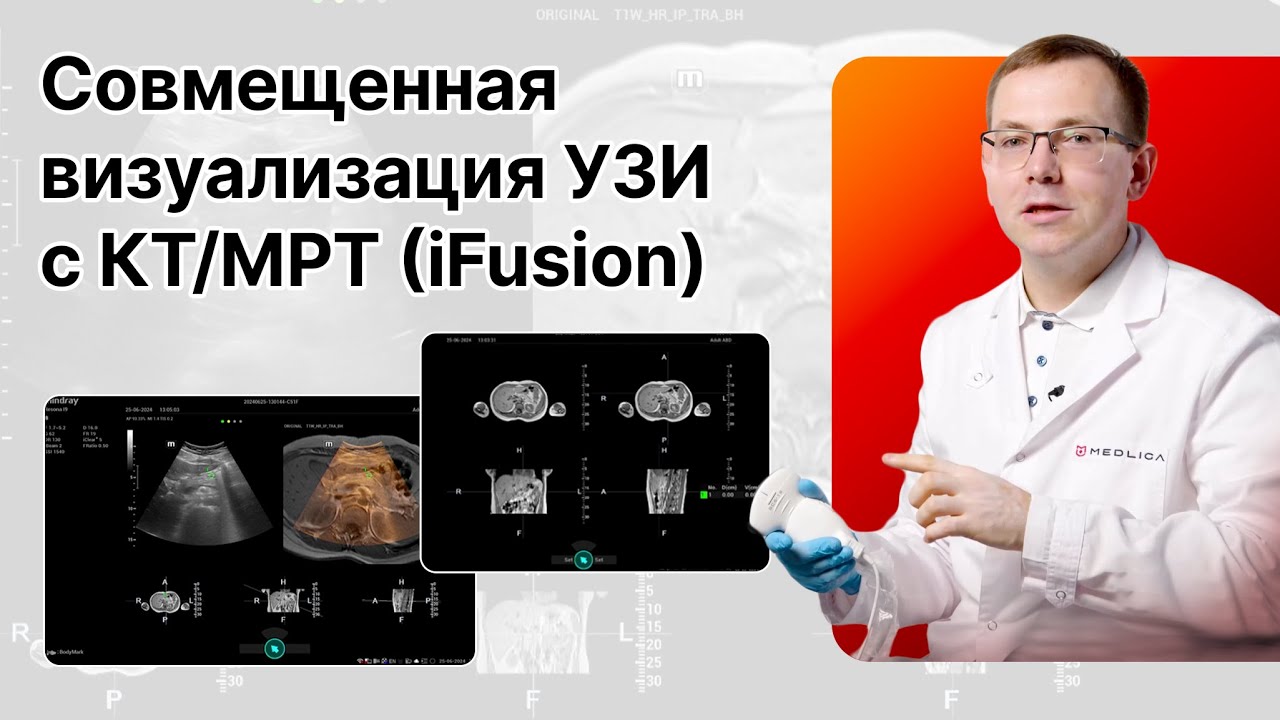 Совмещенная ультразвуковая визуализация (iFusion) с данными КТ/МРТ/ПЭТ
