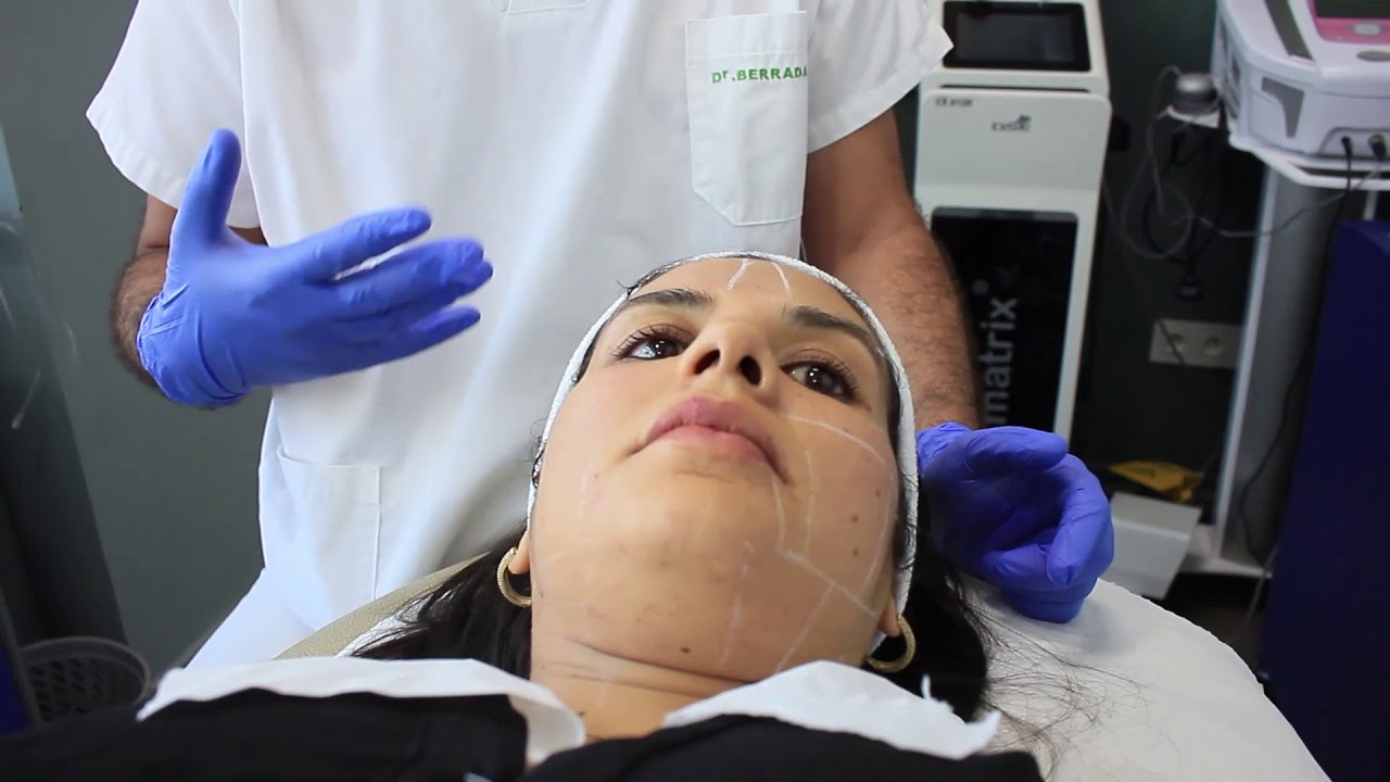 HIFU. Lifting sans chirurgie