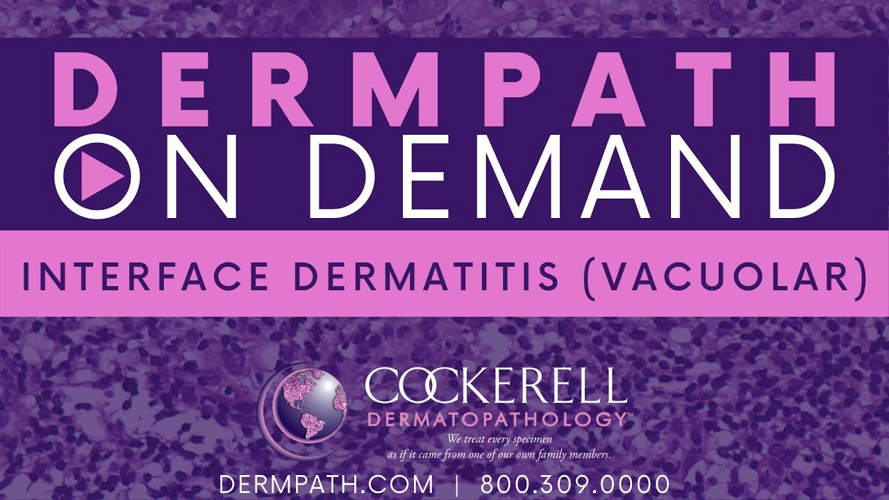 Interface Dermatitis | Vacuolar