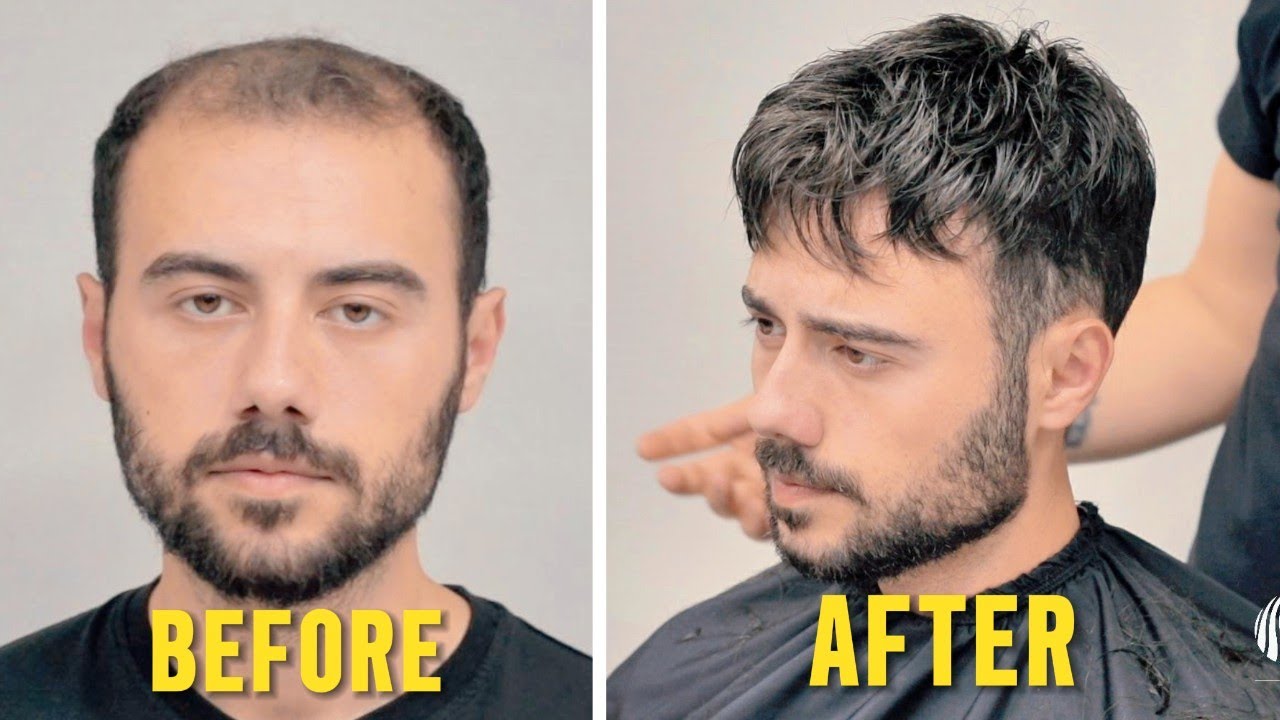 PROTEZ SAÇ İLE İNANILMAZ DEĞİŞİM! - Hair Replacement