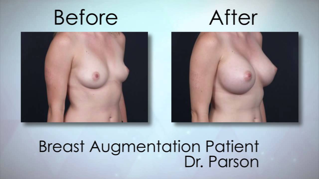 Choosing the Right Sized Implant