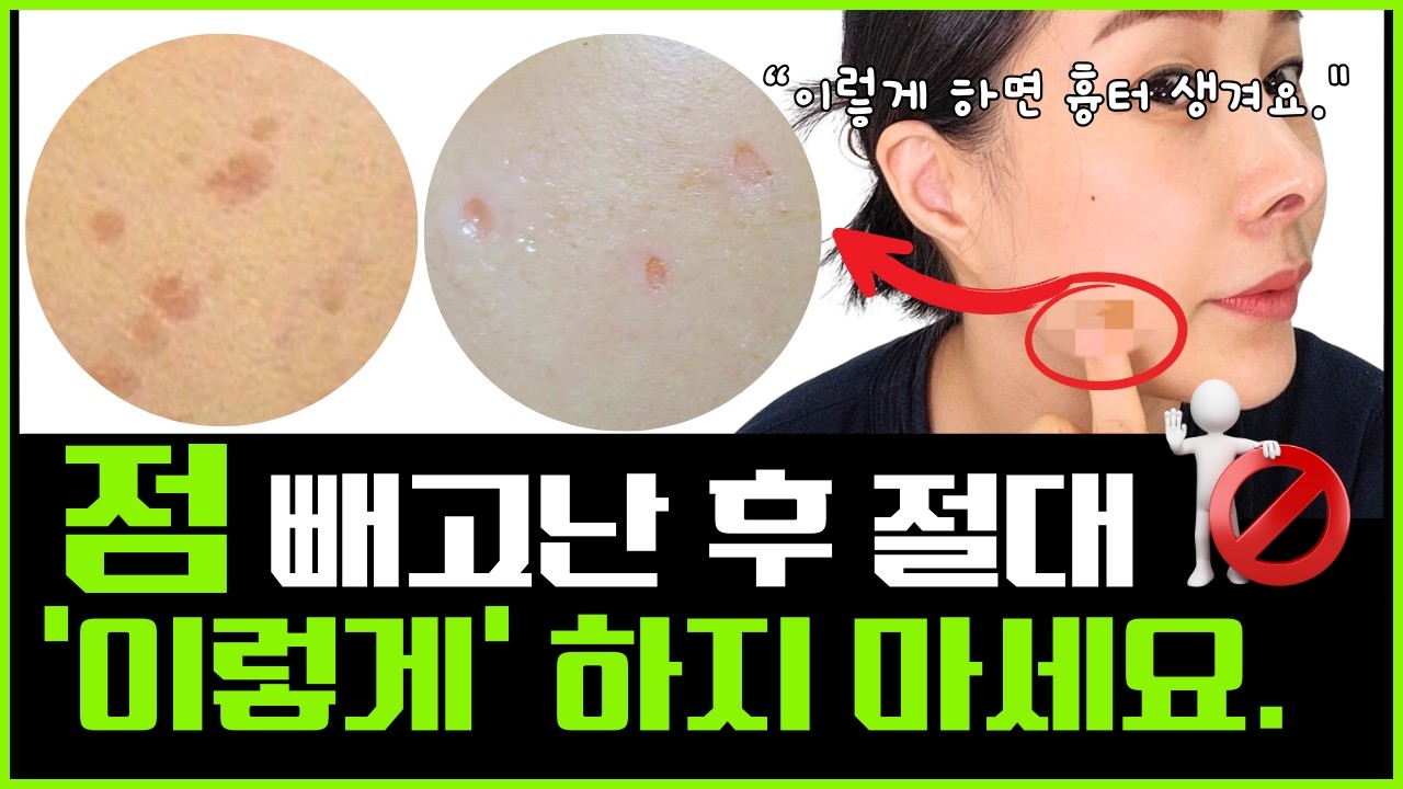 점 뺀 후 관리가 더 중요! 색소침착, 흉터 안생기는 법/이쁘게 점 빼는 법