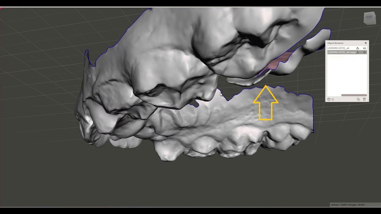MESHMIXER - MODELO COM FALHA DE ESCANEAMENTO NO MOLAR - EM HD