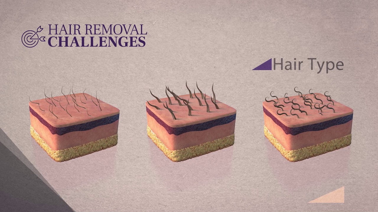 SHR 3D Technology  - Soprano laser hair removal