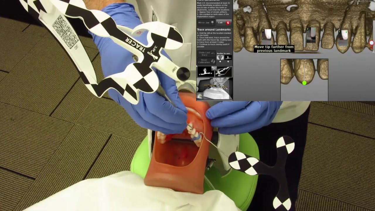Endo: Calcified Canals