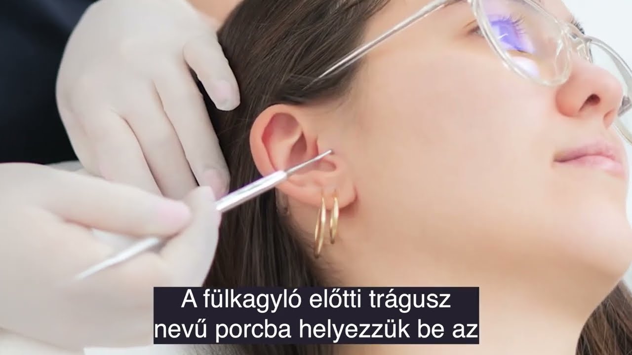 Slim- / Étvágycsökkentő piercing a könnyebb fogyásért
