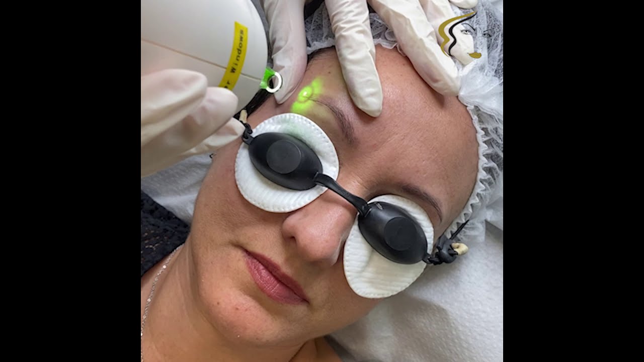 Αφαίρεση tattoo με laser , αφαίρεση Μόνιμου Μακιγιάζ