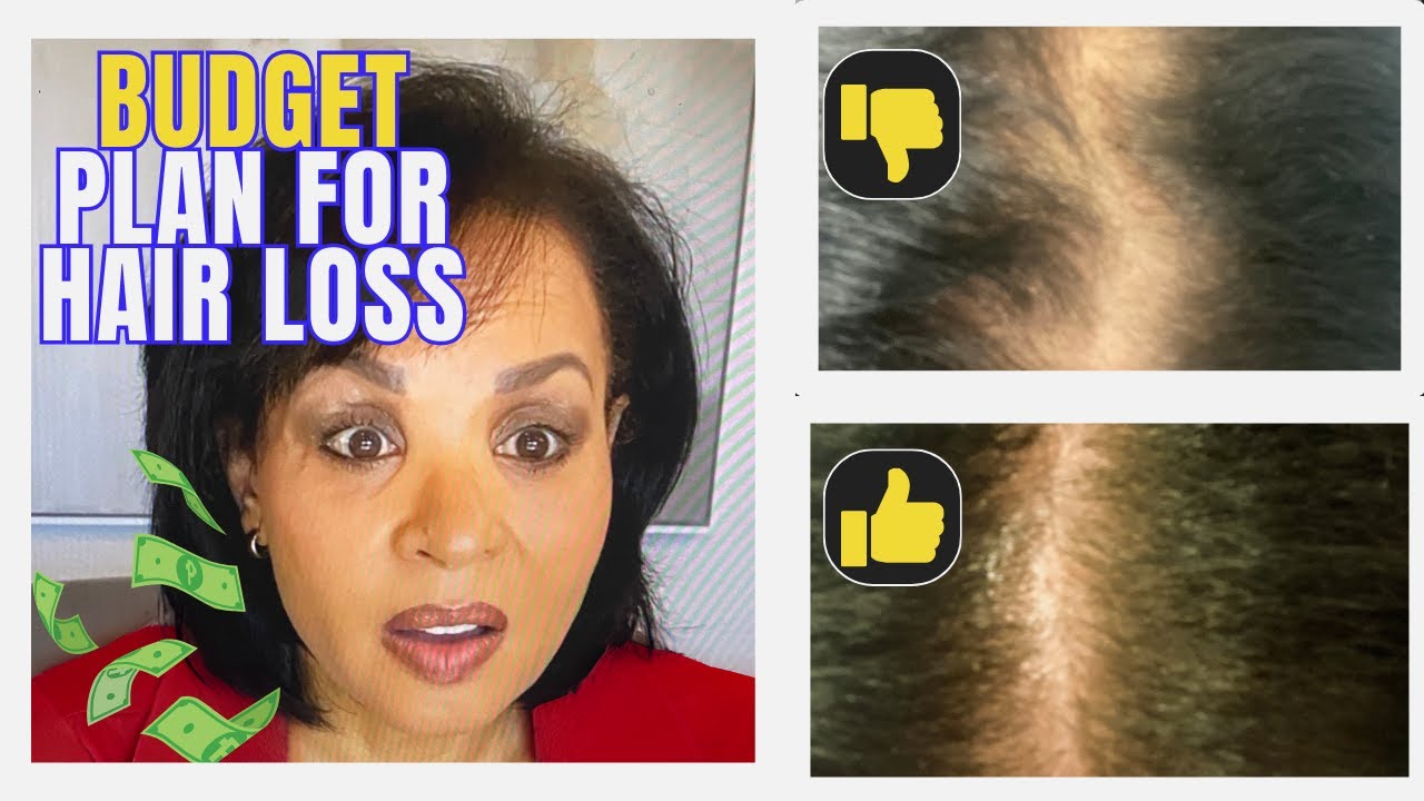 Get Your Hair Back, Even on a Budget! Androgenetic Alopecia