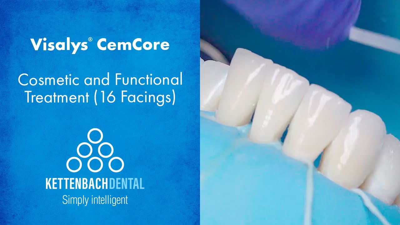 Visalys® CemCore Facings - Cosmetic and Functional Treatment (16 Facings)