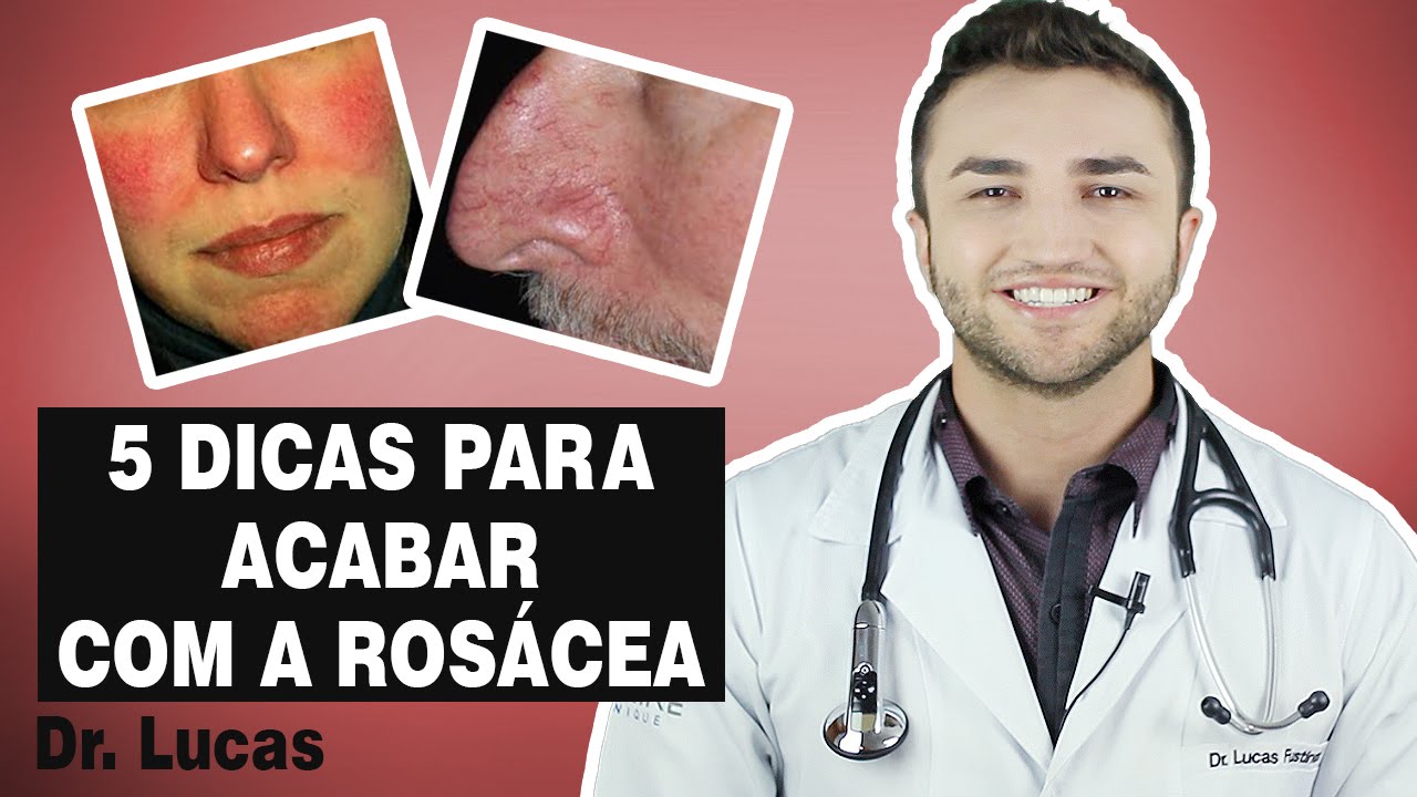 4 Dicas para Combater a Rosácea Vermelhidão no rosto