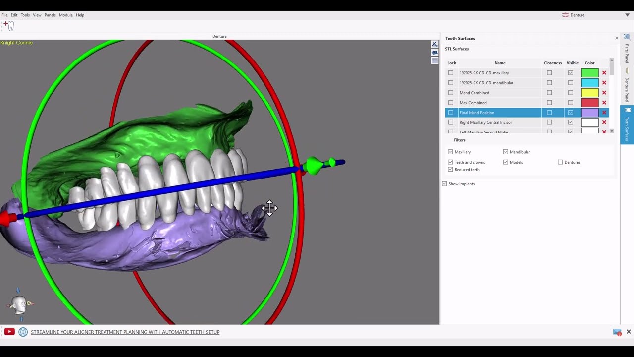 Opening bite of edentulous ridges in Blue Sky Plan